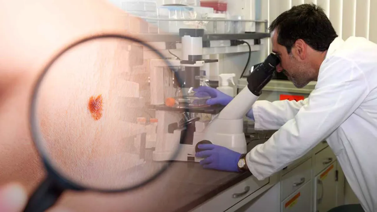 Un proyecto pionero estudia la eficacia de la inmunoterapia en el melanoma infantil