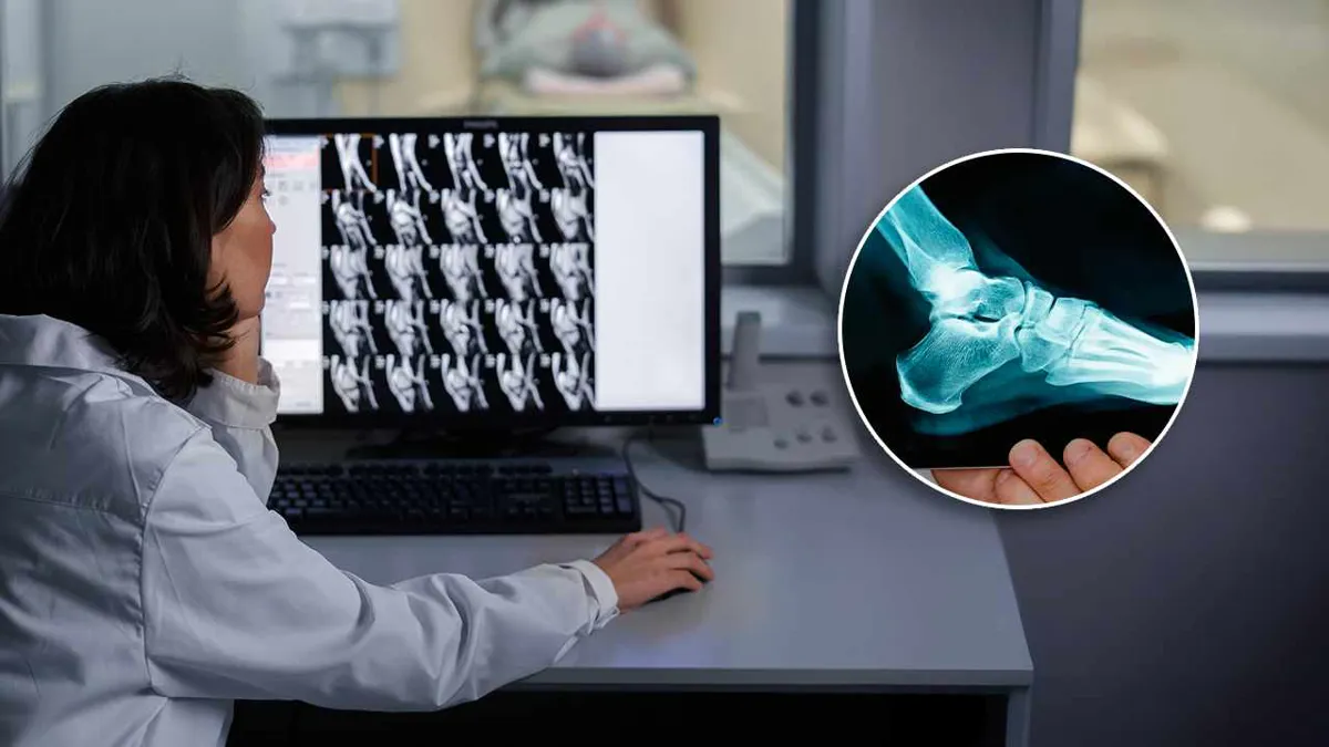 Desarrollan nanocemento óseo para tratamiento de fracturas y reparación rápida